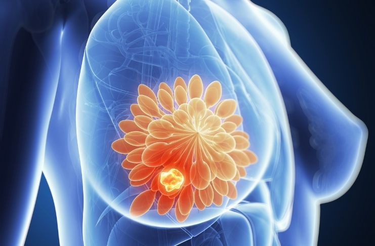 Estudos mostram que molécula em veneno de abelha destrói células de câncer de mama